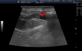 PLE Ultrasound 2